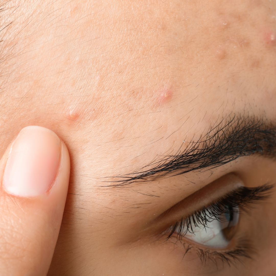 Can African Black Soap Help with Acne?